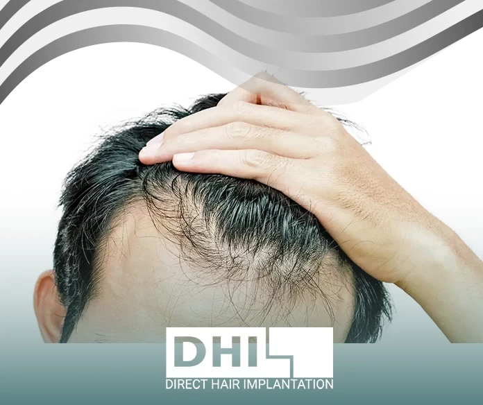 Treat hair loss for men