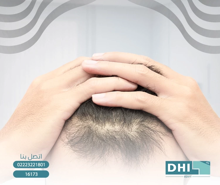 كل ما تريد معرفته عن حقن بلازما للشعر و تكلفته