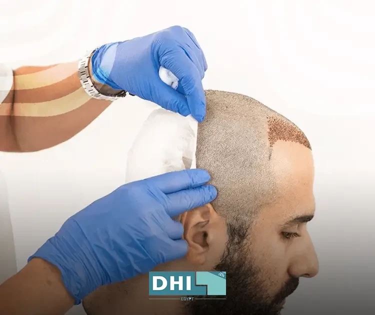 تقنية dhi لزراعة الشعر