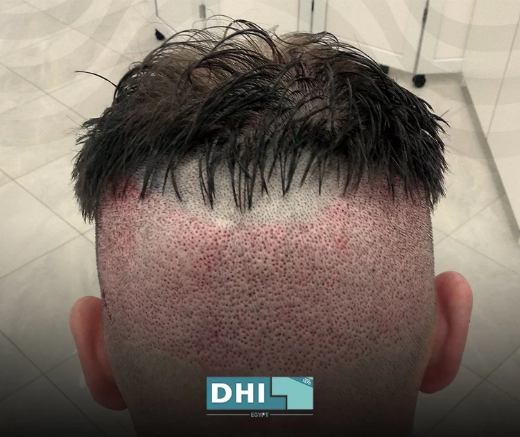 does transplanted hair grow