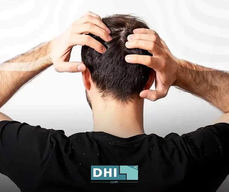 قشرة الشعر بعد الزراعة