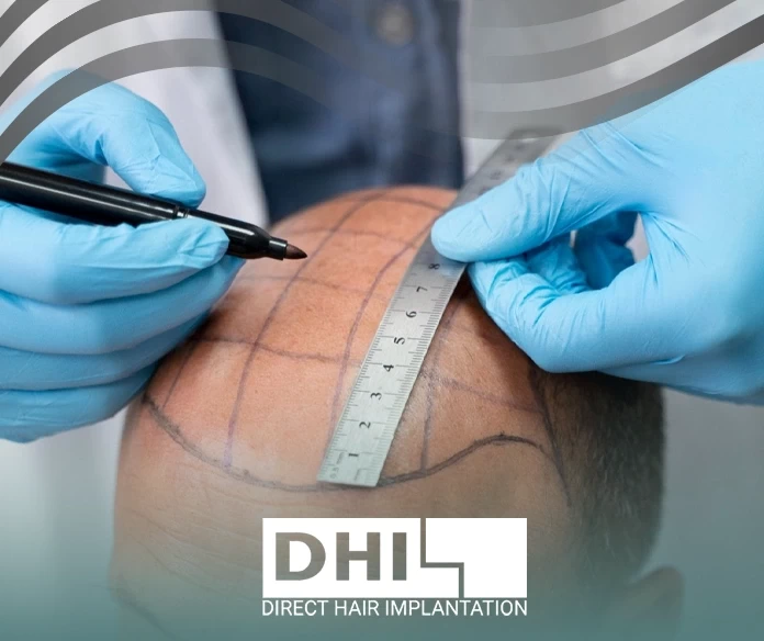 علامات نجاح زراعة الشعر