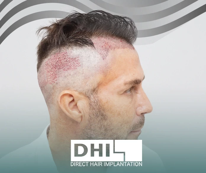 اضرار زراعة الشعر بالليزر