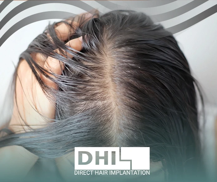 Treat hair loss in women