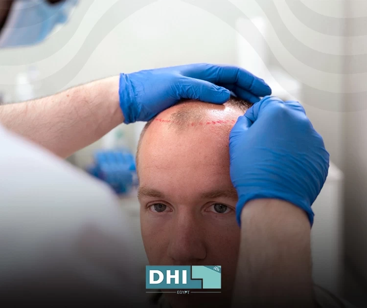 تقنية زراعة الشعر