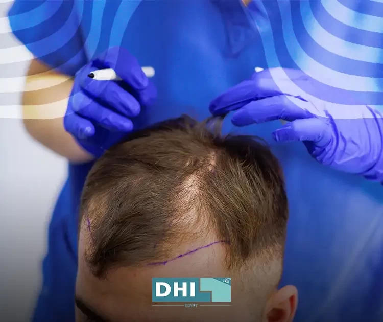 Frontal hair transplantation costs