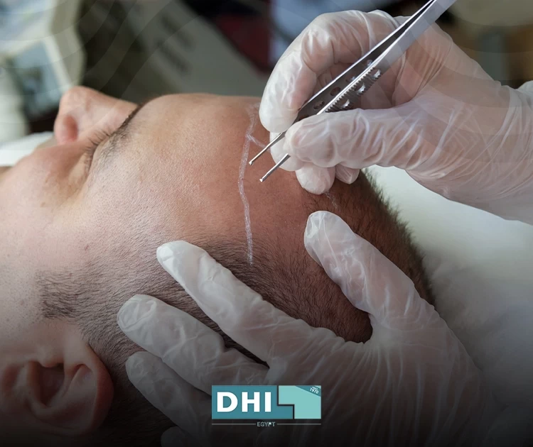 زراعة الشعر قبل وبعد