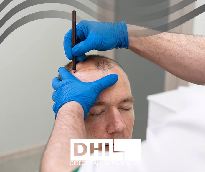 زراعة الشعر بدون منطقة مانحة