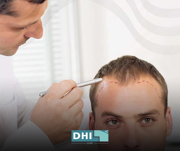 أفضل إجراءات زراعة الشعر