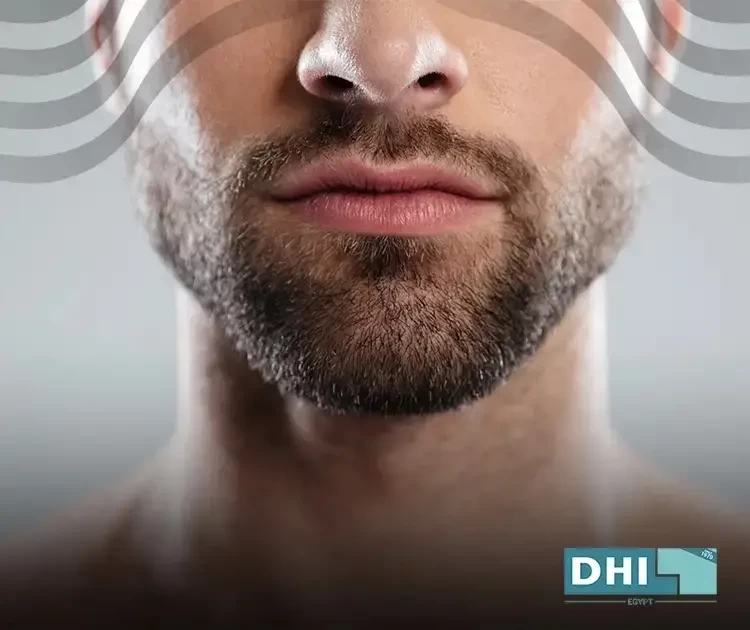 زراعة اللحية بعد شهر