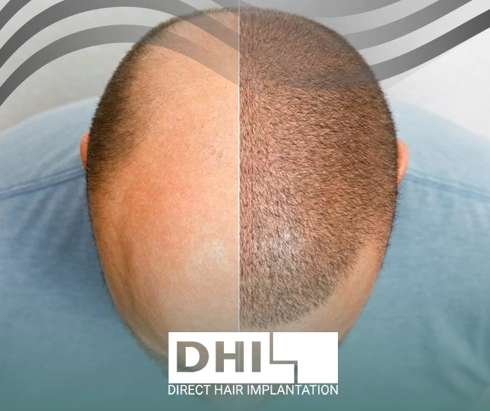 هل زراعة الشعر مضمونه