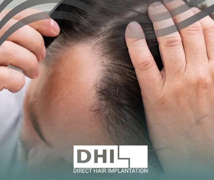 علاج الصلع الوراثي