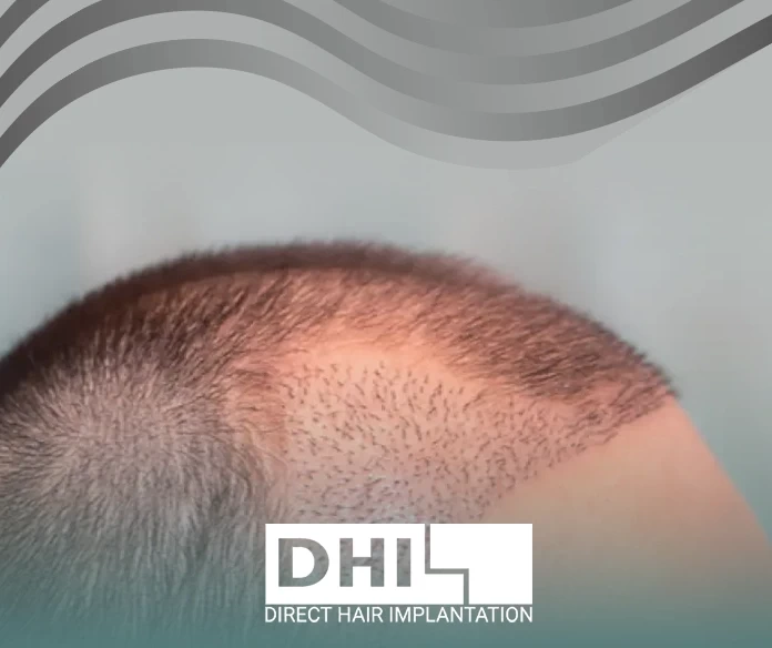 Hair transplant