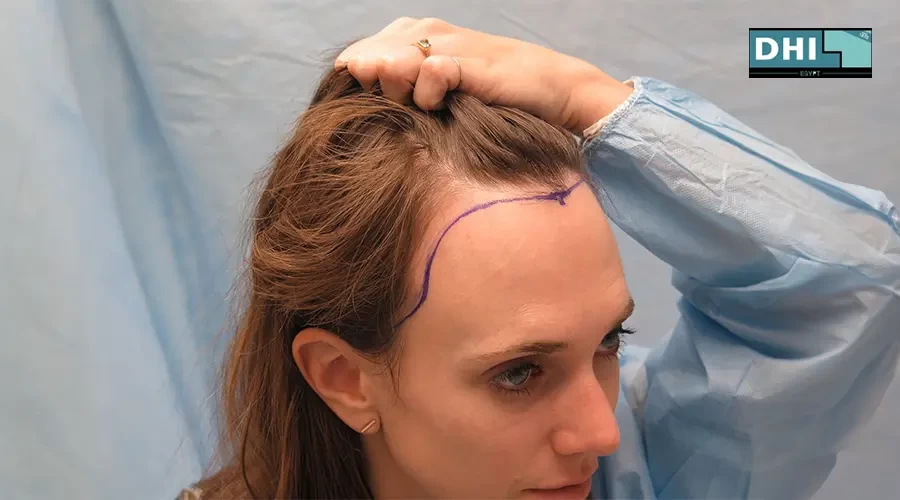 Hair transplant for girls