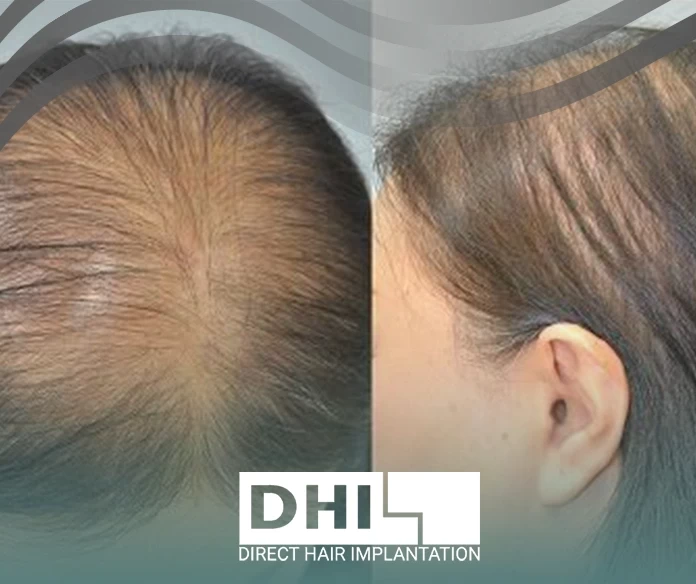 علامات الصلع الوراثي