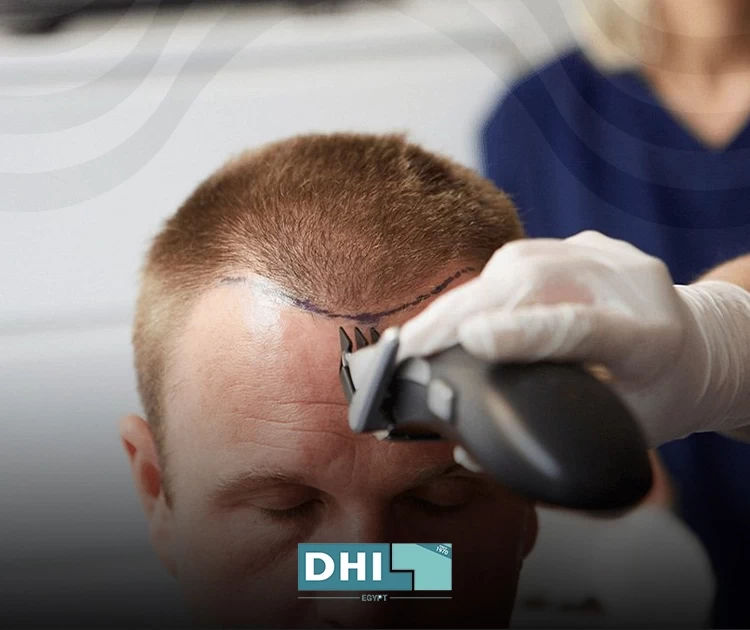 Expert Hair Transplant