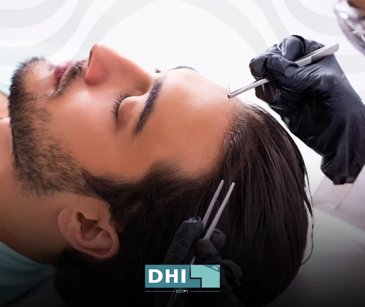 نتائج جراحة زراعة الشعر