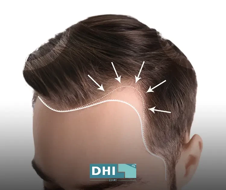 زراعة شعر مقدمة الراس للرجال