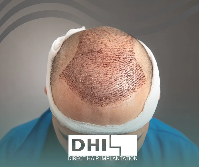 متى يمكن التعرض للشمس بعد زراعة الشعر
