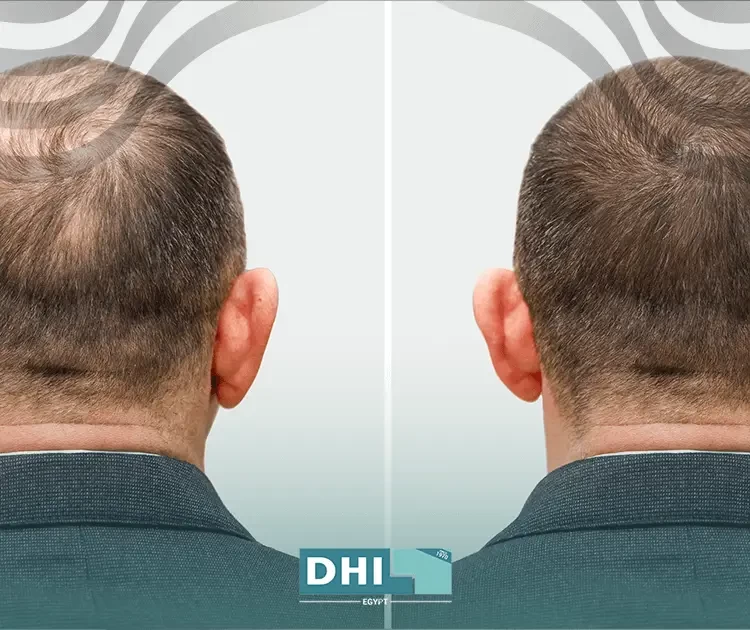 زراعة الشعر مقابل نقل الشعر