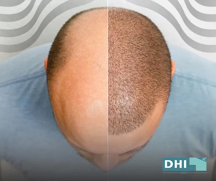 زراعة الشعر بتقنية FUE