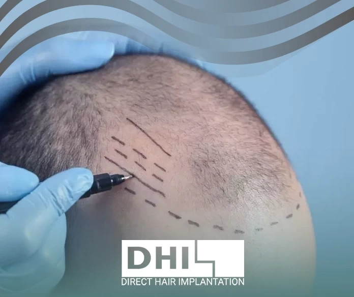Hair transplant method