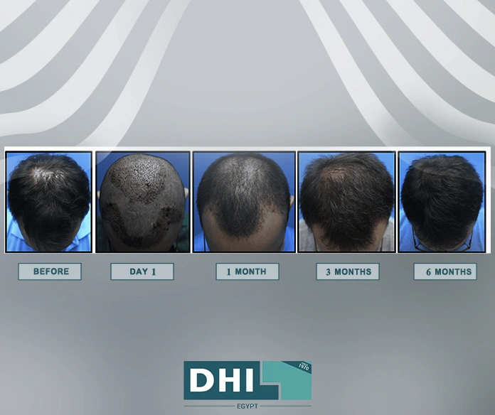 مراحل زراعة الشعر