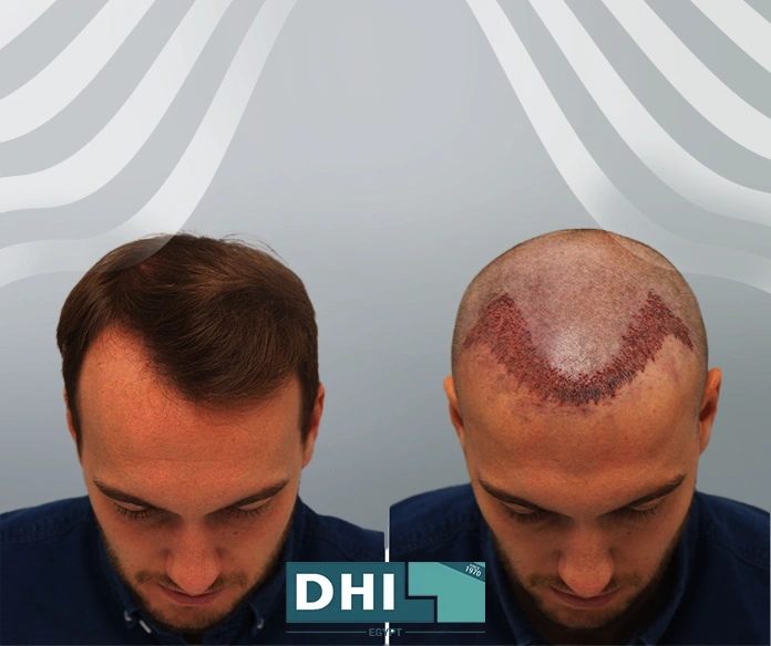 فراغات بعد زراعة الشعر