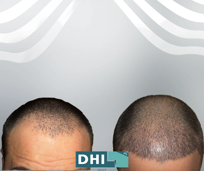 بعد ٢٠ يوم من زراعة الشعر