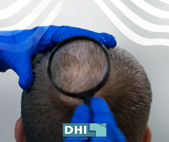 متى تثبت البصيلات بعد زراعة الشعر