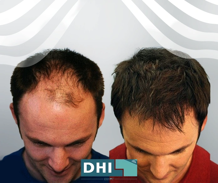 نتائج زراعة الشعر بعد 3 شهور