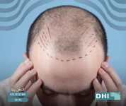 تحفيز نمو الشعر عن طريق حقن البلازما