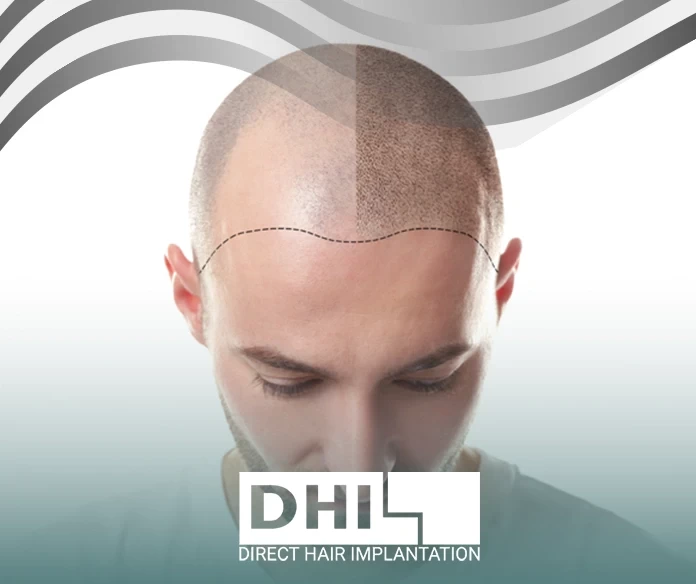 best hair transplant treatment