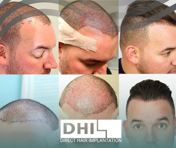 مراحل زراعة الشعر
