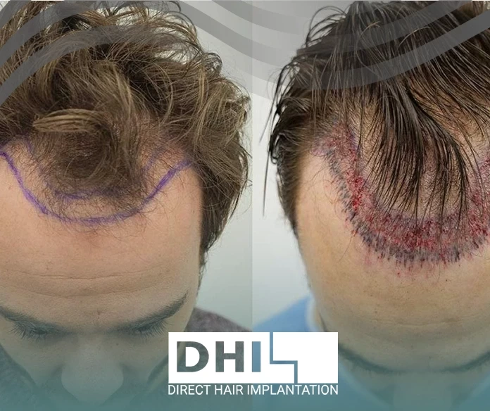 Best hair transplant surgeon