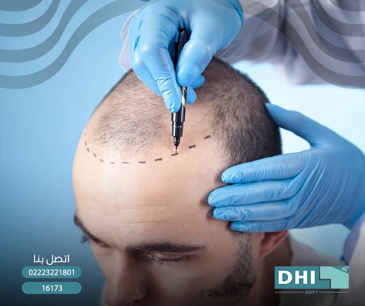 تقنية زراعة الشعر المباشرة (DHI)